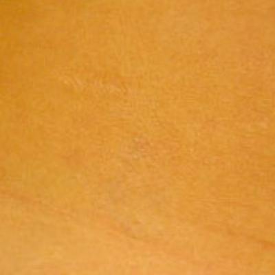 Laser Skin Treatments Before & After Gallery - Patient 195935 - Image 2