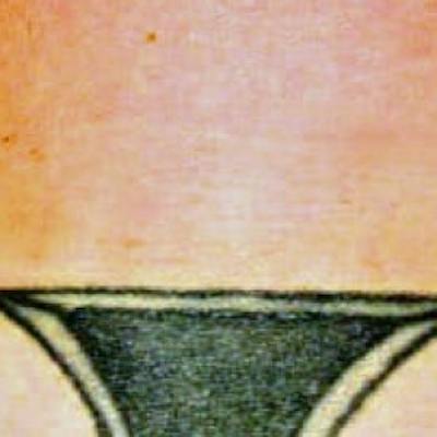 Laser Skin Treatments Before & After Gallery - Patient 230955 - Image 2