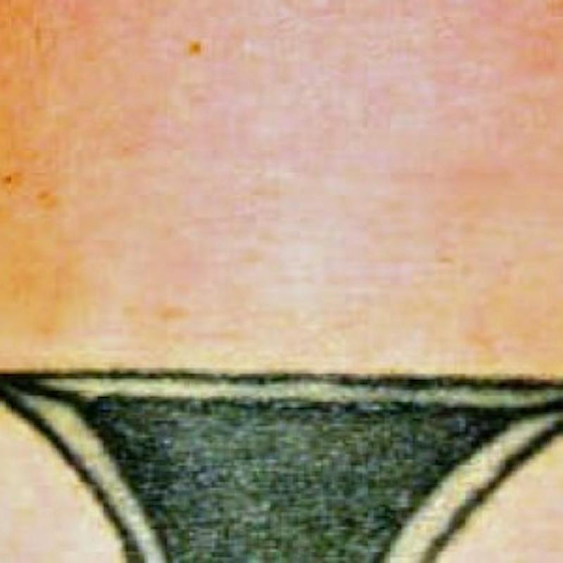 Laser Skin Treatments Before & After Gallery - Patient 230955 - Image 2