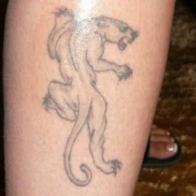 Laser Skin Treatments Before & After Gallery - Patient 279013 - Image 1