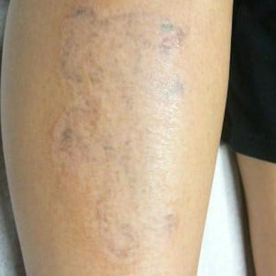 Laser Skin Treatments Before & After Gallery - Patient 279013 - Image 2