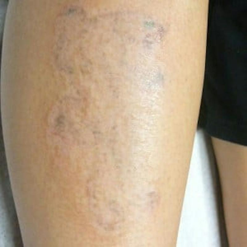 Laser Skin Treatments Before & After Gallery - Patient 279013 - Image 2