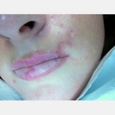 Laser Skin Treatments Before & After Gallery - Patient 347043 - Image 1