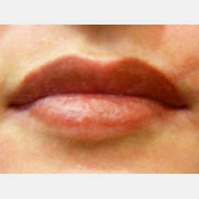 Laser Skin Treatments Before & After Gallery - Patient 347043 - Image 2
