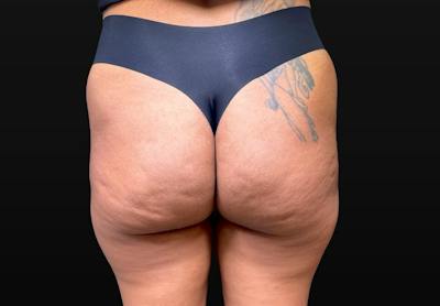 Aveli Cellulite Removal Before & After Gallery - Patient 151408 - Image 1