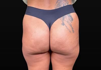 Aveli Cellulite Removal Before & After Gallery - Patient 151408 - Image 2