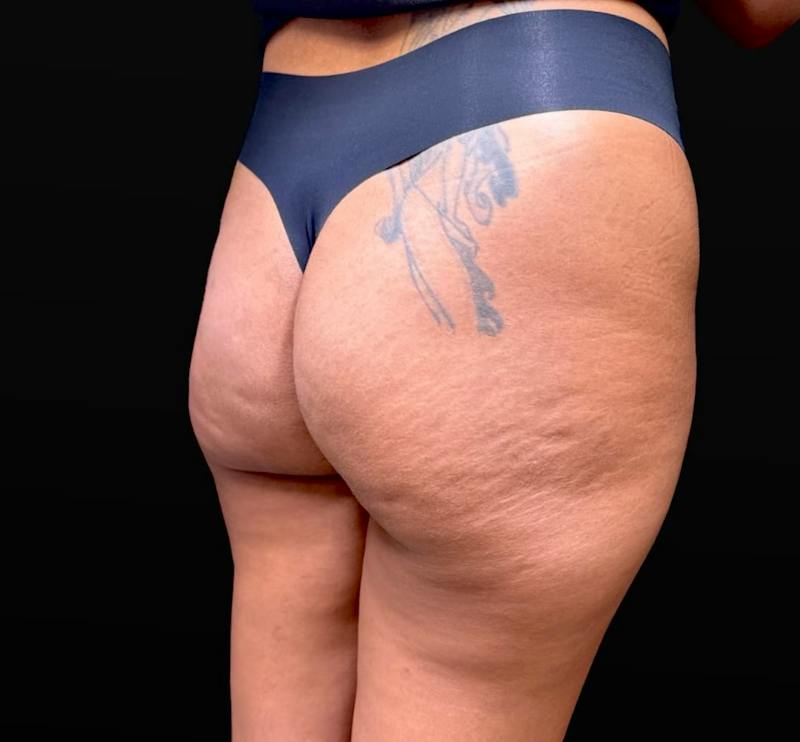Aveli Cellulite Removal Before & After Gallery - Patient 151408 - Image 3