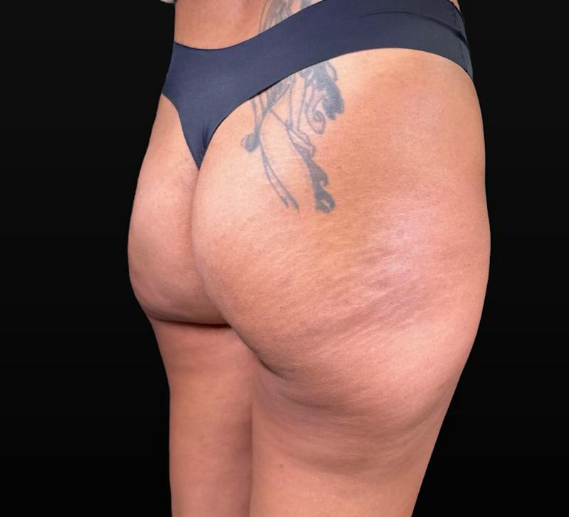 Aveli Cellulite Removal Before & After Gallery - Patient 151408 - Image 4