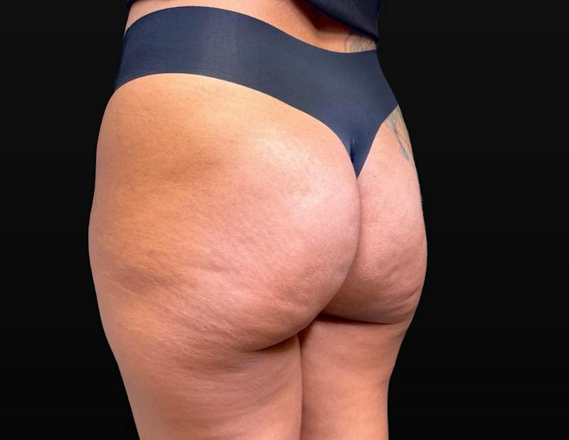 Aveli Cellulite Removal Before & After Gallery - Patient 151408 - Image 5