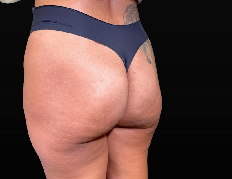 Aveli Cellulite Removal Before & After Gallery - Patient 151408 - Image 6
