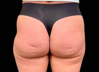 Aveli Cellulite Removal Before & After Gallery - Patient 276799 - Image 1