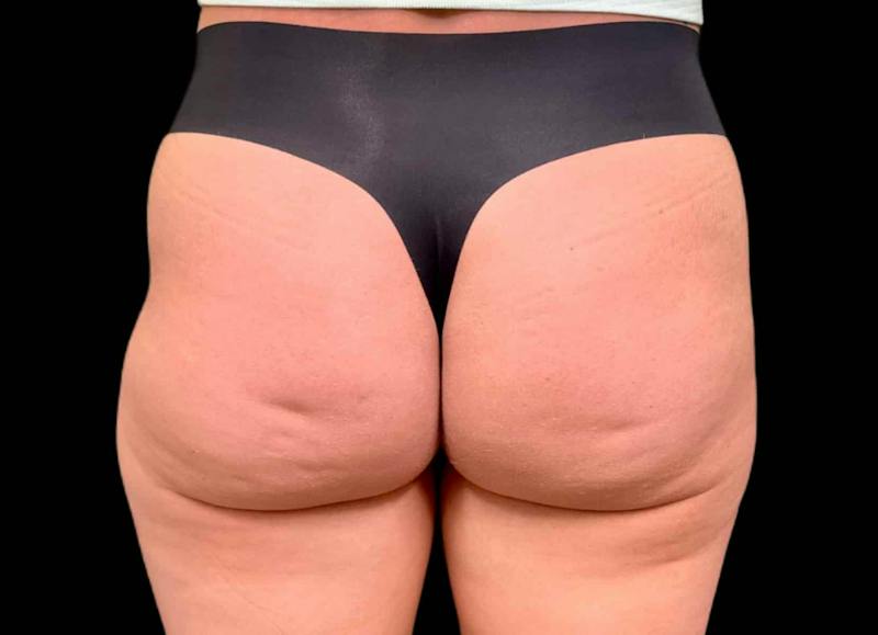 Aveli Cellulite Removal Before & After Gallery - Patient 276799 - Image 1