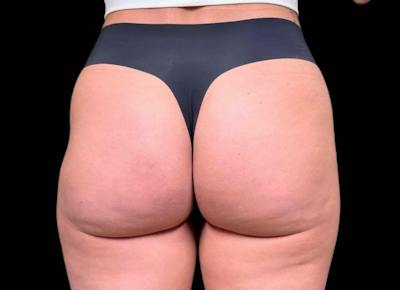 Aveli Cellulite Removal Before & After Gallery - Patient 276799 - Image 2