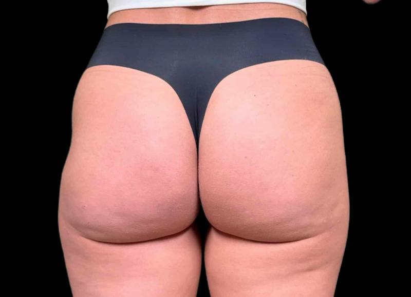 Aveli Cellulite Removal Before & After Gallery - Patient 276799 - Image 2