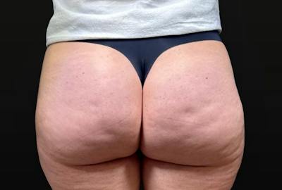 Aveli Cellulite Removal Before & After Gallery - Patient 207967 - Image 1