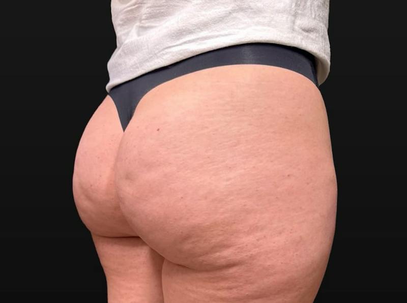 Aveli Cellulite Removal Before & After Gallery - Patient 207967 - Image 3