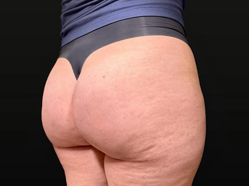 Aveli Cellulite Removal Before & After Gallery - Patient 207967 - Image 4