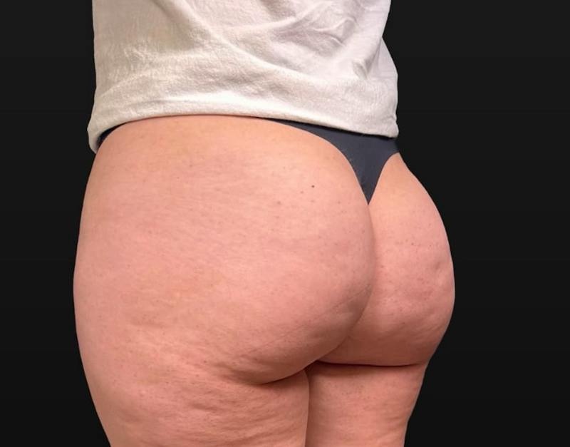 Aveli Cellulite Removal Before & After Gallery - Patient 207967 - Image 5