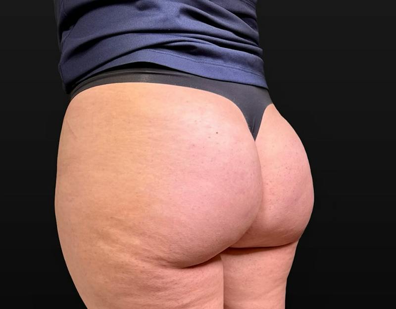 Aveli Cellulite Removal Before & After Gallery - Patient 207967 - Image 6