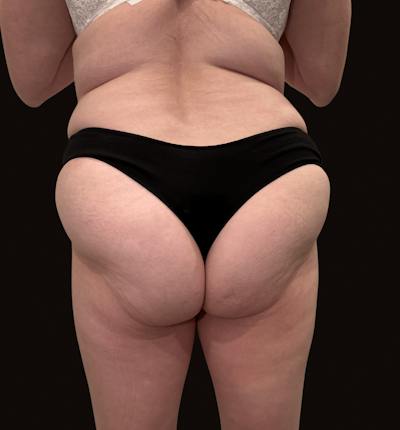 Body Contouring Before & After Gallery - Patient 151202 - Image 1