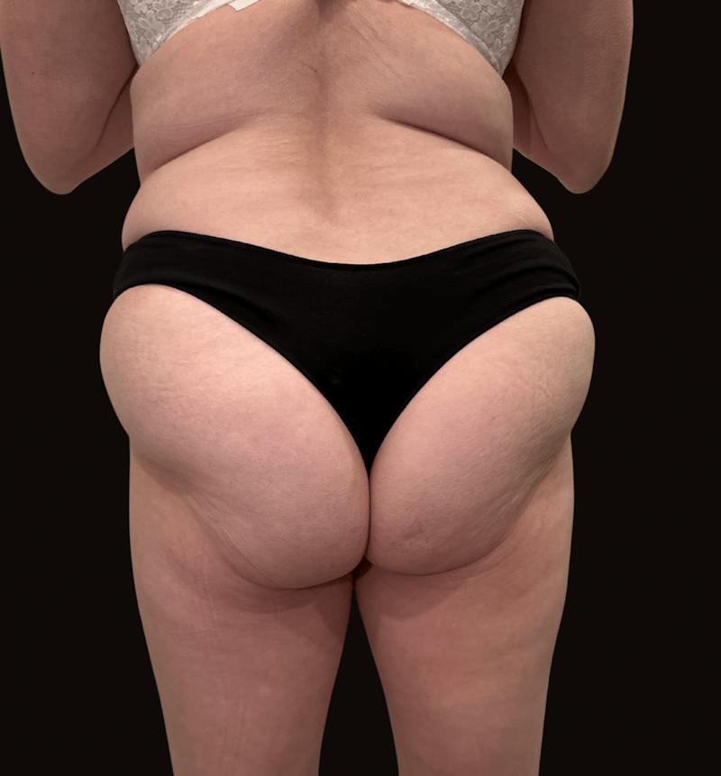 Emsculpt Neo Before & After Gallery - Patient 183733 - Image 1