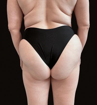 Body Contouring Before & After Gallery - Patient 151202 - Image 2