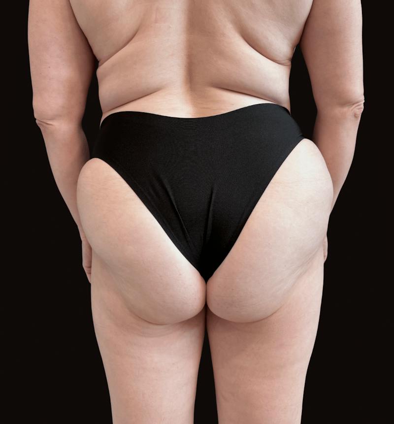 Emsculpt Neo Before & After Gallery - Patient 183733 - Image 2