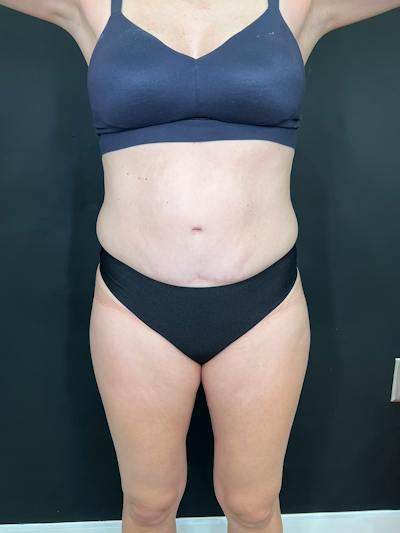 Body Contouring Before & After Gallery - Patient 205678 - Image 1
