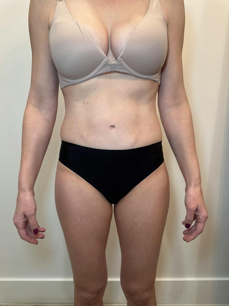 Body Contouring Before & After Gallery - Patient 205678 - Image 2