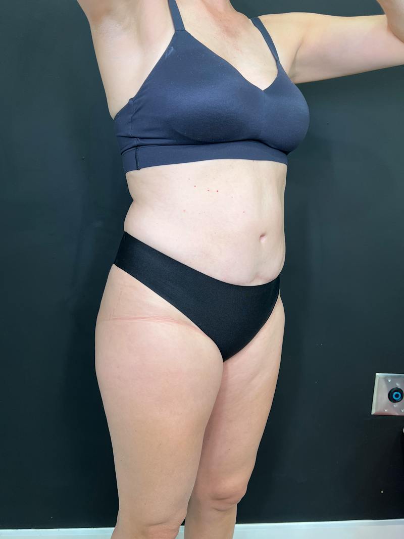 Body Contouring Before & After Gallery - Patient 205678 - Image 3
