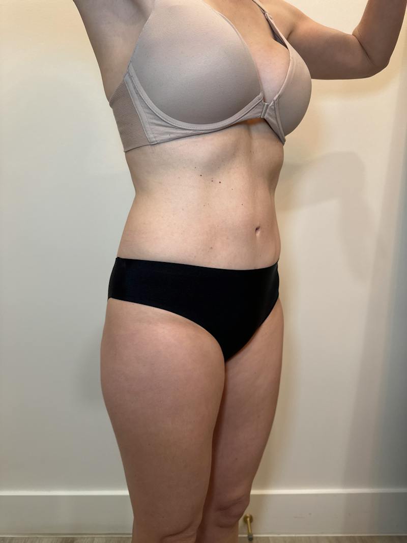 Body Contouring Before & After Gallery - Patient 205678 - Image 4