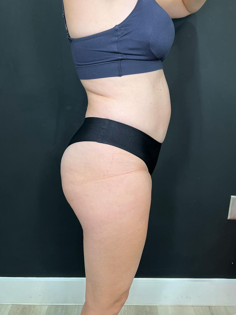 Body Contouring Before & After Gallery - Patient 205678 - Image 5
