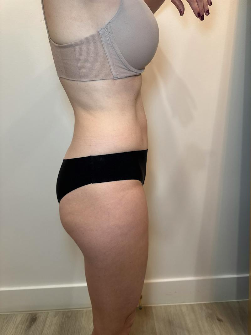 Body Contouring Before & After Gallery - Patient 205678 - Image 6