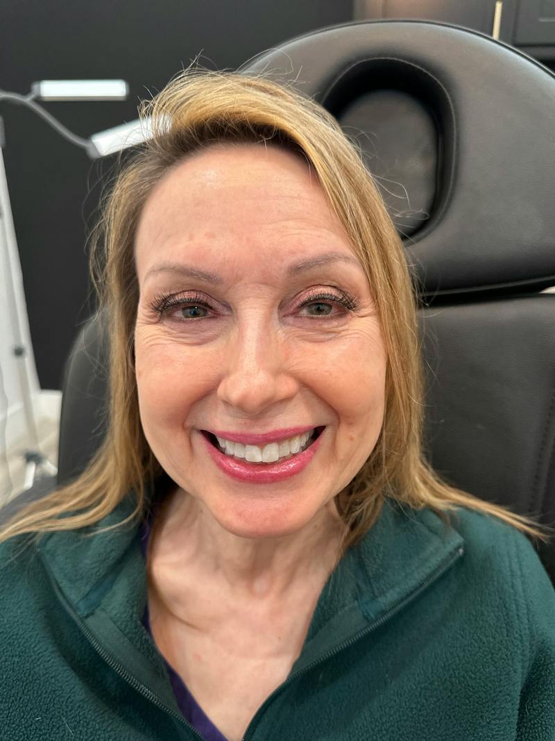 BOTOX Before & After Gallery - Patient 169979 - Image 1