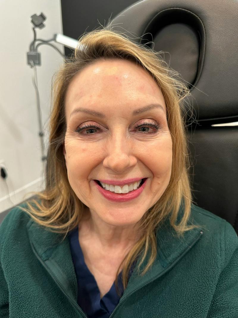 BOTOX Before & After Gallery - Patient 169979 - Image 2