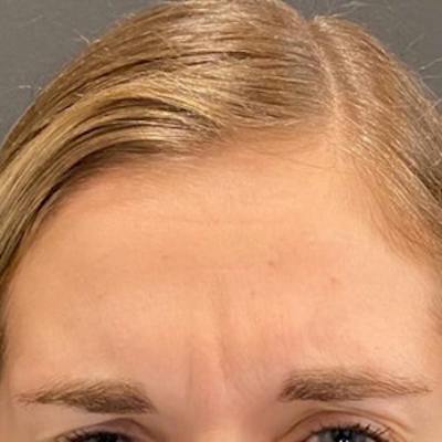 BOTOX Before & After Gallery - Patient 414906 - Image 1