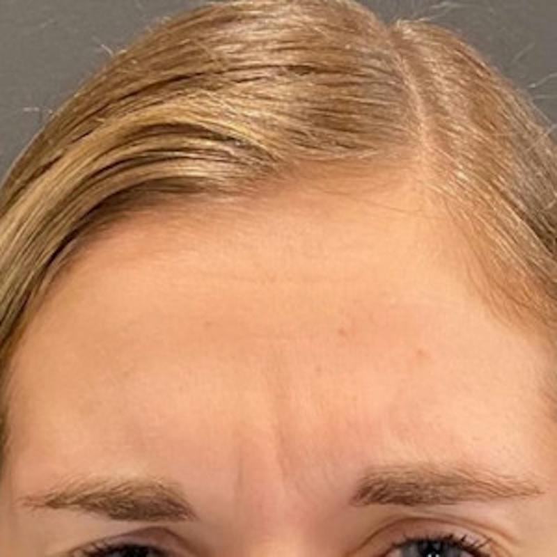 BOTOX Before & After Gallery - Patient 414906 - Image 1