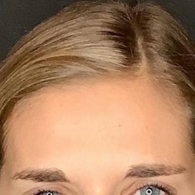 BOTOX Before & After Gallery - Patient 414906 - Image 2