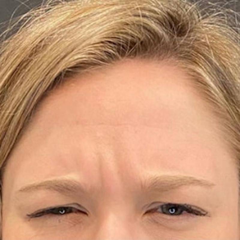 BOTOX Before & After Gallery - Patient 414906 - Image 3