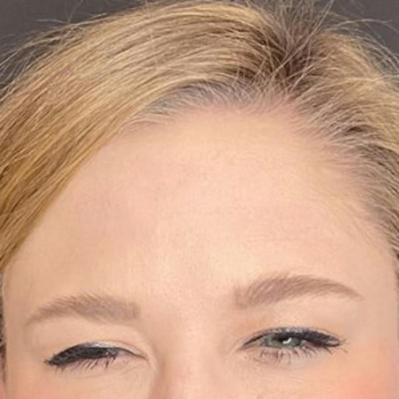 BOTOX Before & After Gallery - Patient 414906 - Image 4