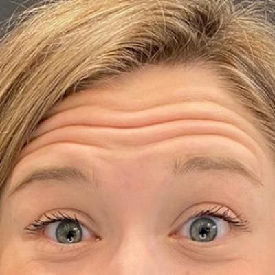 BOTOX Before & After Gallery - Patient 361507 - Image 1