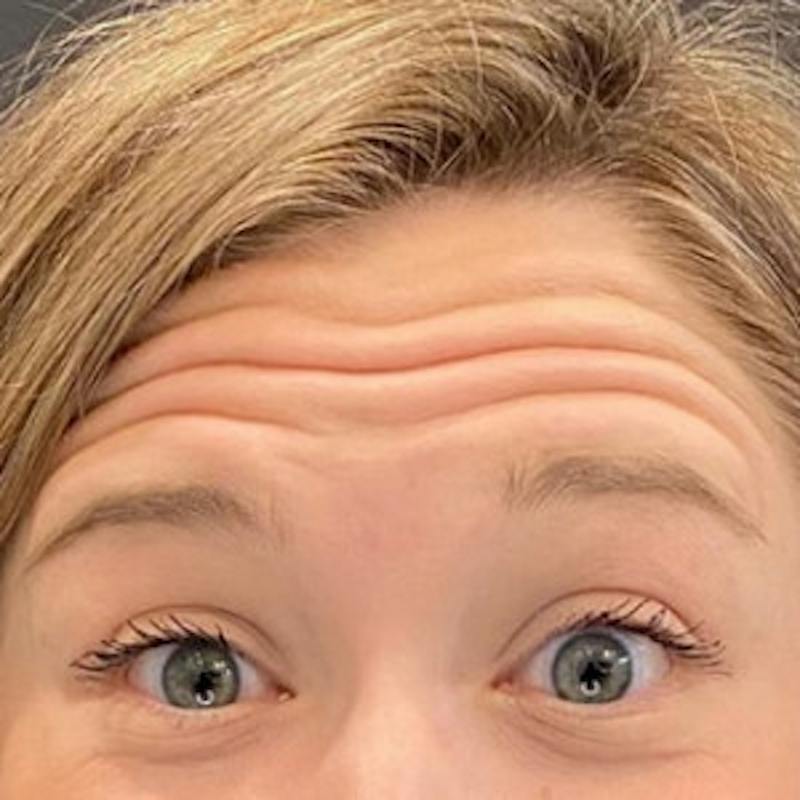 BOTOX Before & After Gallery - Patient 361507 - Image 1