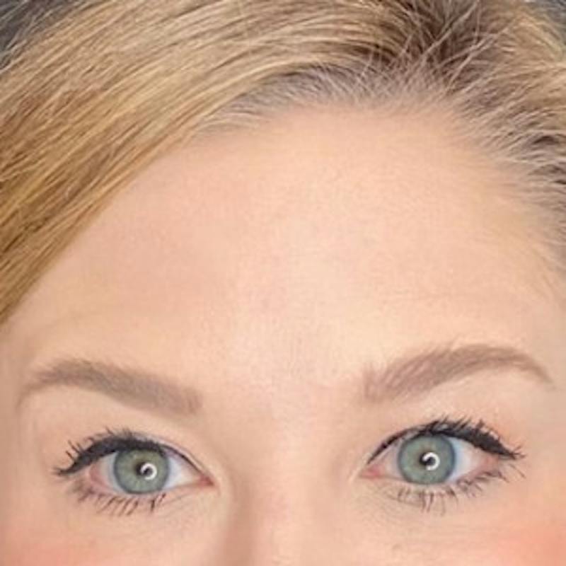 BOTOX Before & After Gallery - Patient 361507 - Image 2