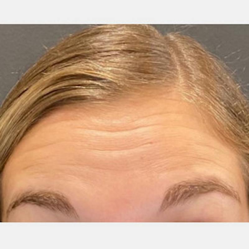 BOTOX Before & After Gallery - Patient 361507 - Image 3