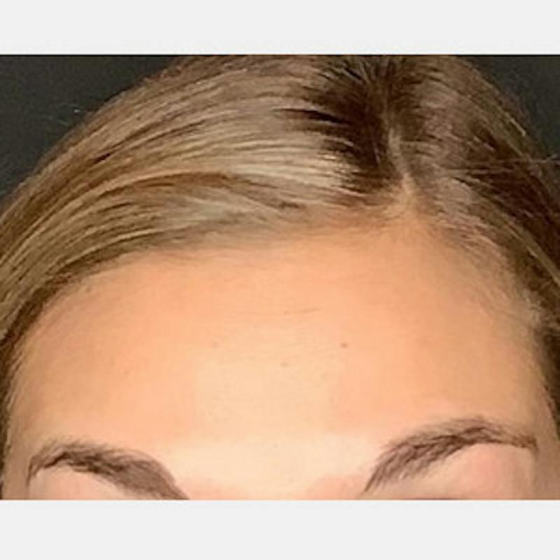 BOTOX Before & After Gallery - Patient 361507 - Image 4