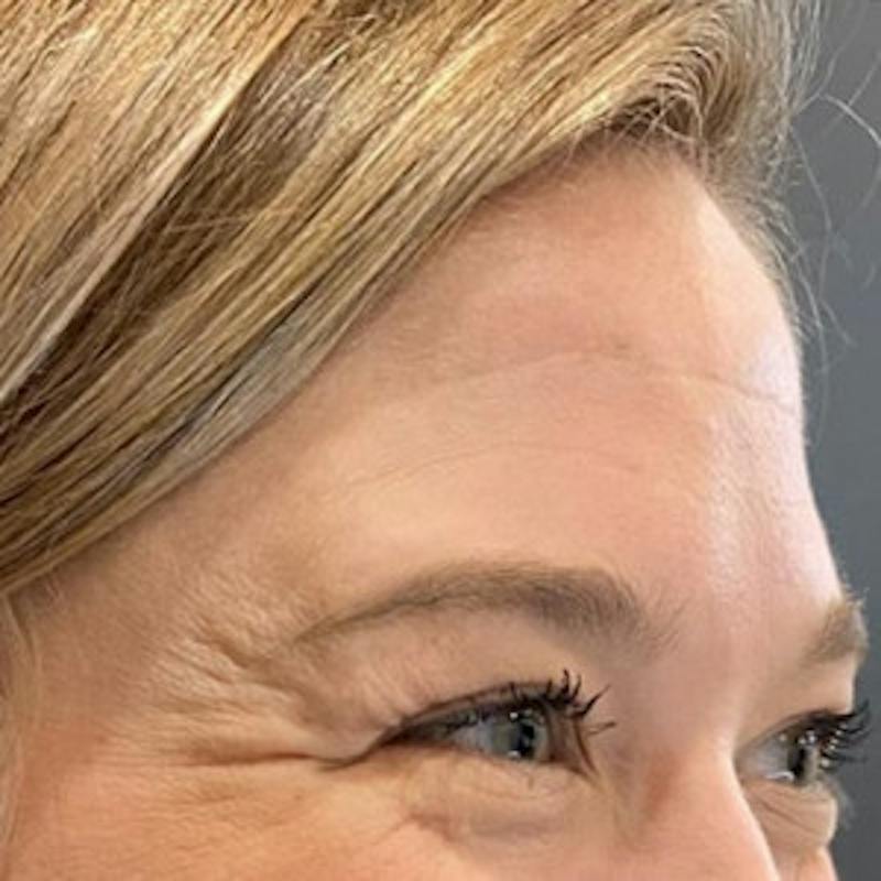 BOTOX Before & After Gallery - Patient 361507 - Image 5