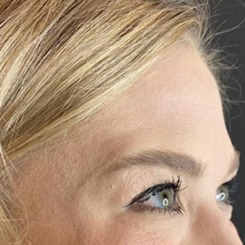BOTOX Before & After Gallery - Patient 361507 - Image 6