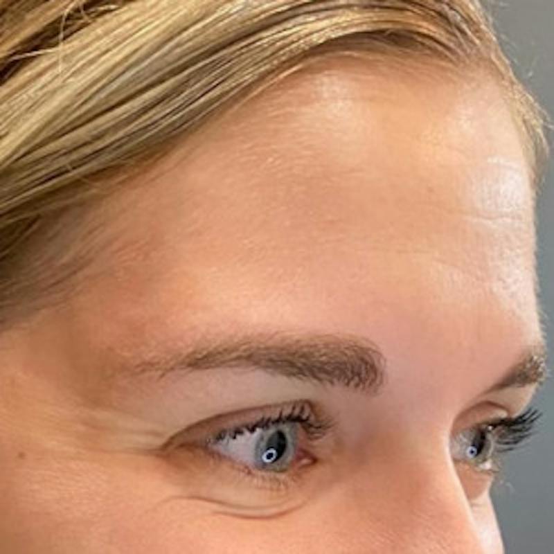 BOTOX Before & After Gallery - Patient 361507 - Image 7
