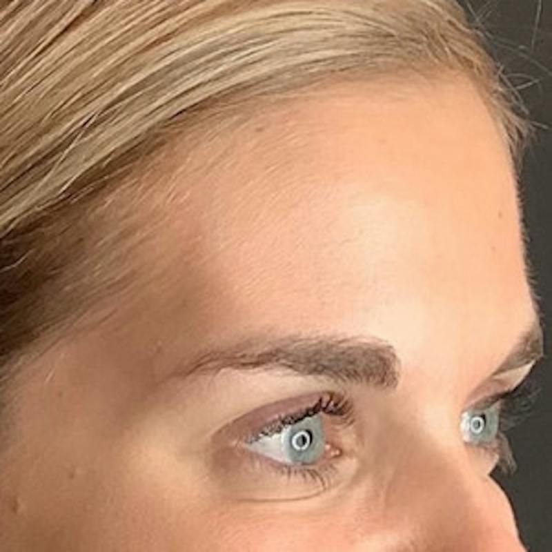 BOTOX Before & After Gallery - Patient 361507 - Image 8