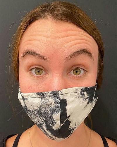 BOTOX Before & After Gallery - Patient 122903 - Image 1